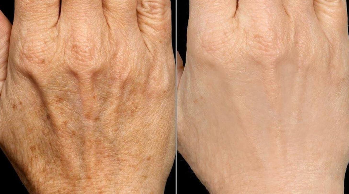 Before and after comparison of hand skin pigmentation treatment